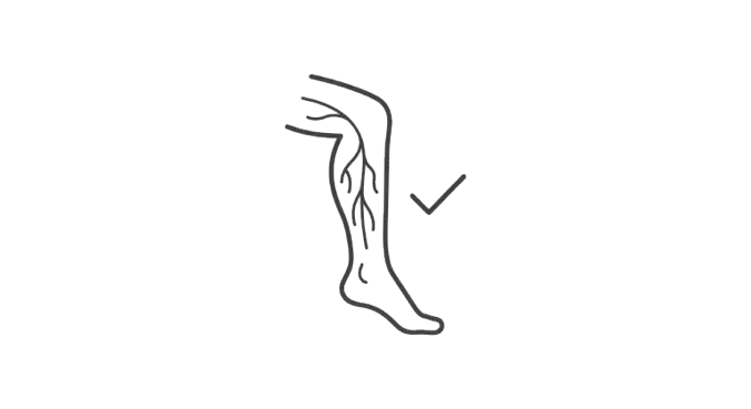 Illustration of varicose veins on leg showing bulging veins requiring treatment