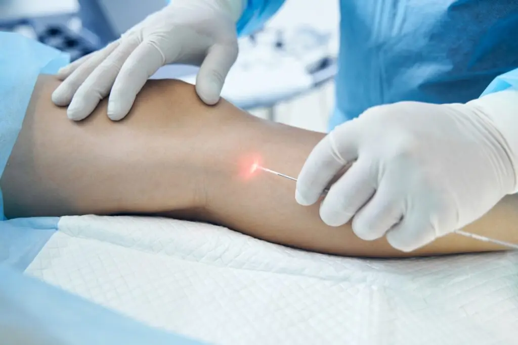 Doctor performing endovenous laser ablation (EVLA) treatment for varicose veins in Sydney
